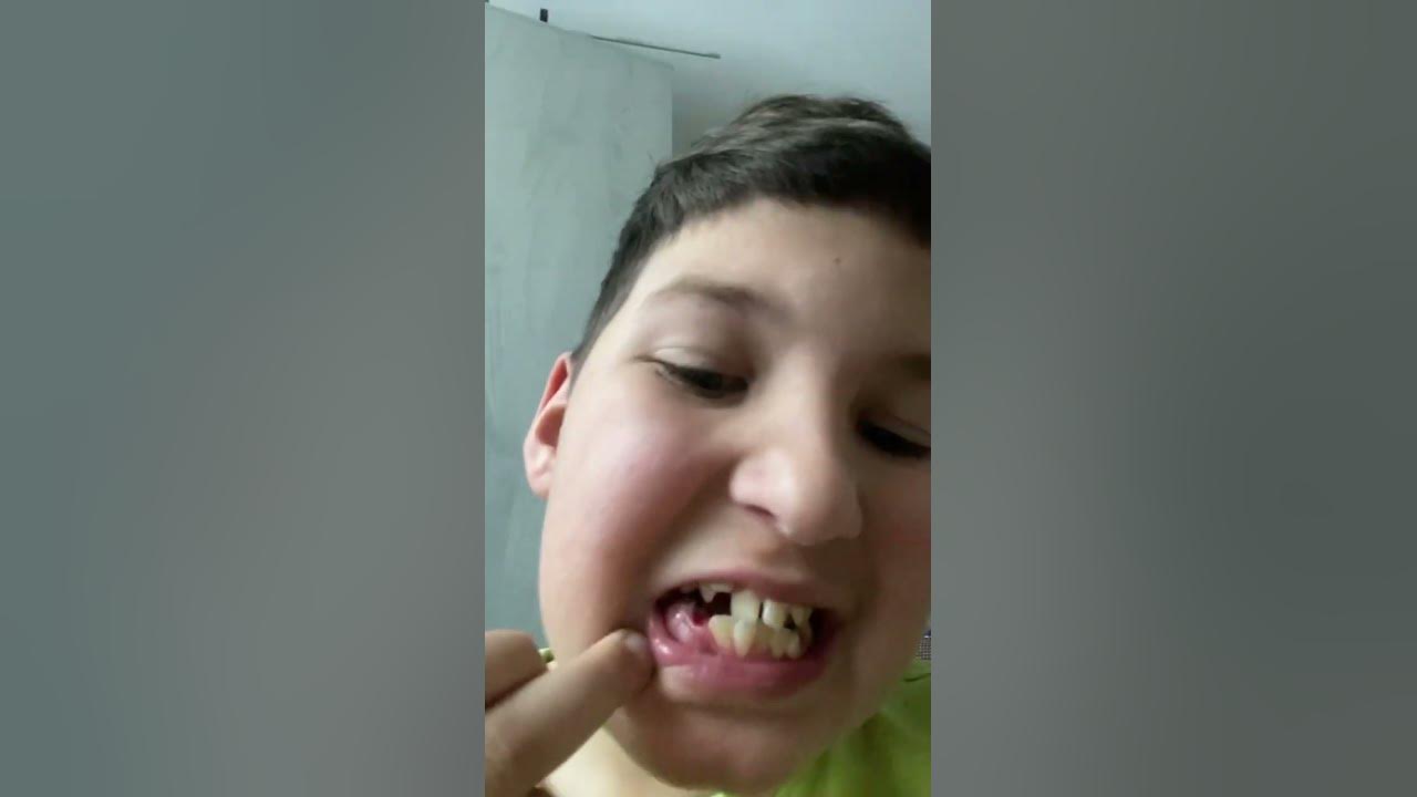 Я стал без зубика ;) - YouTube