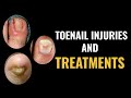 How do I treat a toenail injury?