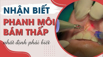 Cách Nhận Biết Phanh Môi Bám Thấp Và Phẫu Thuật Cắt  Phanh Môi Trên| Nha khoa Đặng Xá - S-Dental