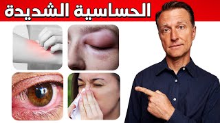 علاج طبيعي للصدمة التحسسية (الحساسية الشديدة)