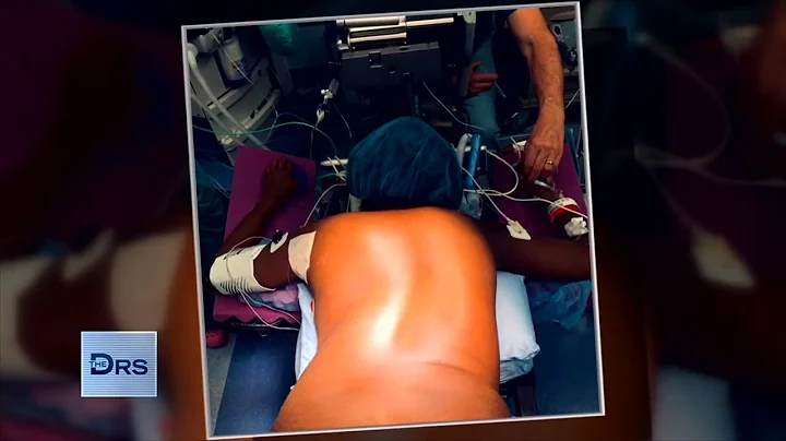 Woman with Extreme Scoliosis Undergoes Life-Changing Surgery to Correct It