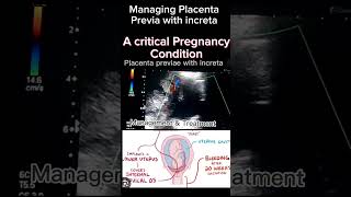 Surgical and Medical Approaches to Placenta Previa with Increta Dr Saimakhan
