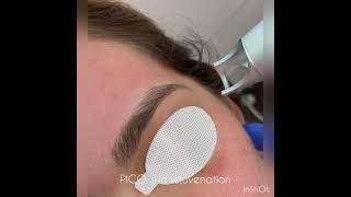 PICO laser Skin Rejuvenation