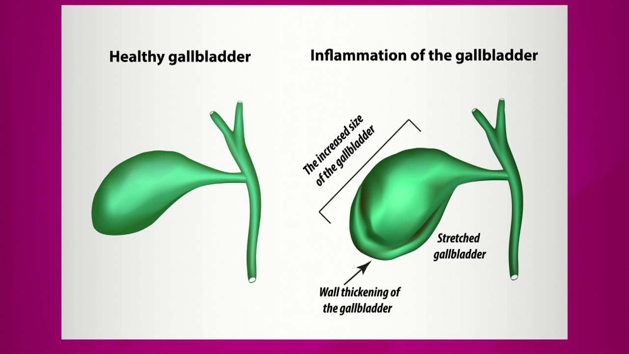 How Do You Know If Your Gallbladder Is Inflamed?