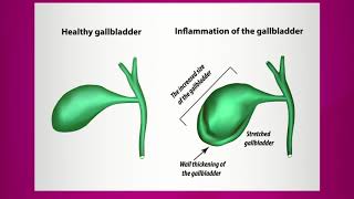 Pain Caused By Gallbladder Inflammation