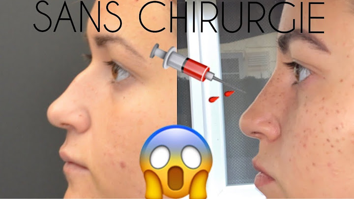 J'ai refais mon nez !! Comment enlever la bosse du nez sans chirurgie ???