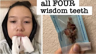 4 Wisdom Teeth Removed in 1 Day - My Recovery! screenshot 3