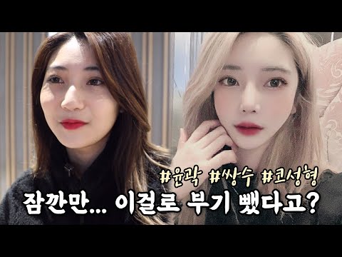 안면윤곽 3종 + 심한 매부리코 수술 후 부기 "이것" 만 하면 쫙 빠져요(?) 엄청난 꿀팁 전수?🍯짝짝이 눈은 쌍수 매몰, 눈매교정, 뒷트임으로 잡고 얼굴 지방이식까지❣[쀼]