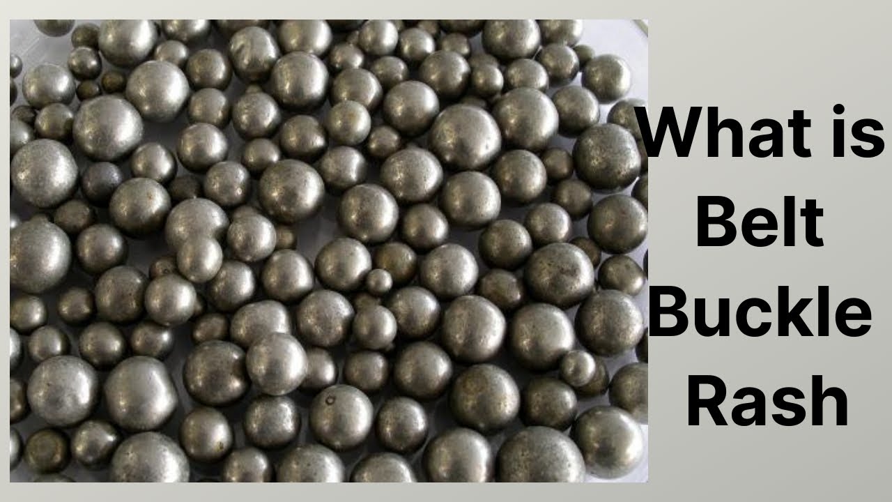 What is Belt Buckle Rash YouTube