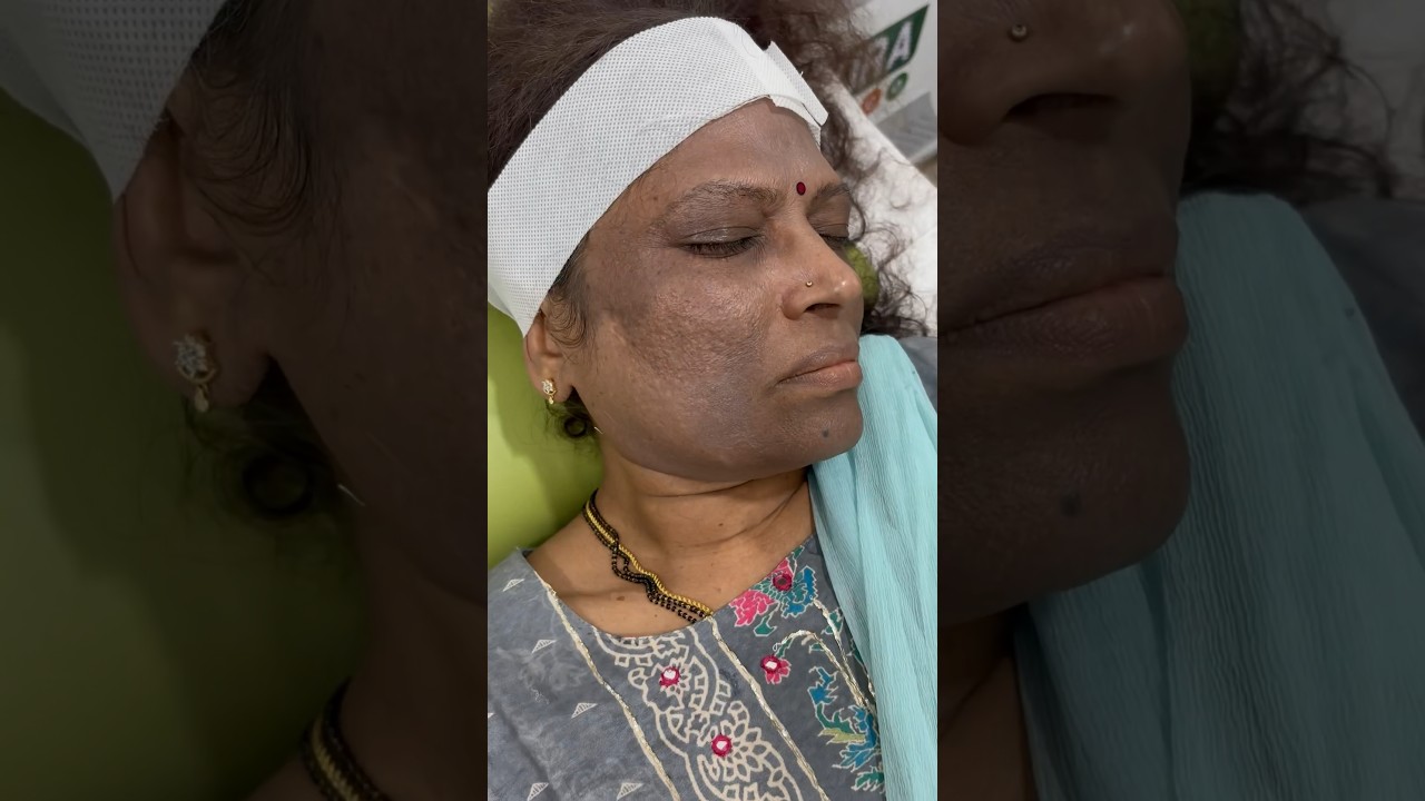 Laser treatment for dark skin layer