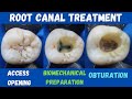 Root canal treatment  mandibular first permanent molar  access opening  bmp  obturation 