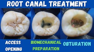 Root Canal Treatment 🔵 Mandibular First Permanent Molar 🟡 access opening ⚪️ BMP 🟣 obturation 🔴