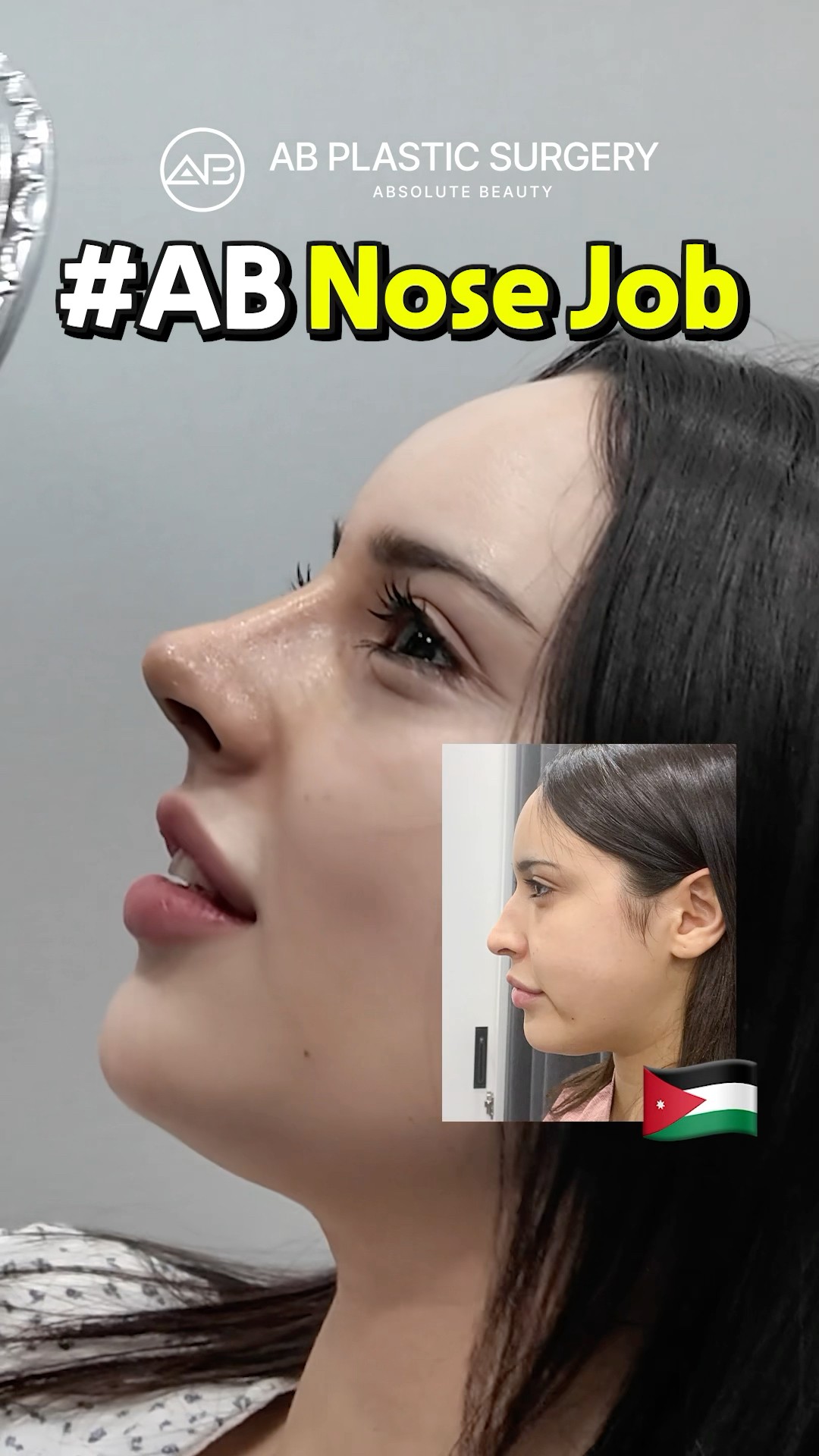 Nose Job Transformation Hump Nose Before & After #koreanplasticsurgery
