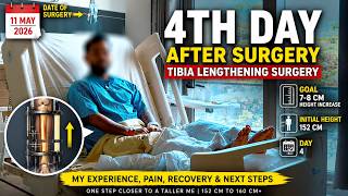 Height Increase Journey begins | Goal 7-8 CM Tibia Lengthening Surgery | Patient Review