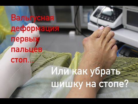 Как убирают шишки на стопе?