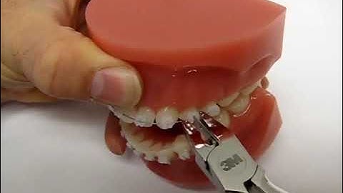 Debonding 3M™ Clarity™ Advanced Ceramic Brackets on the archwire