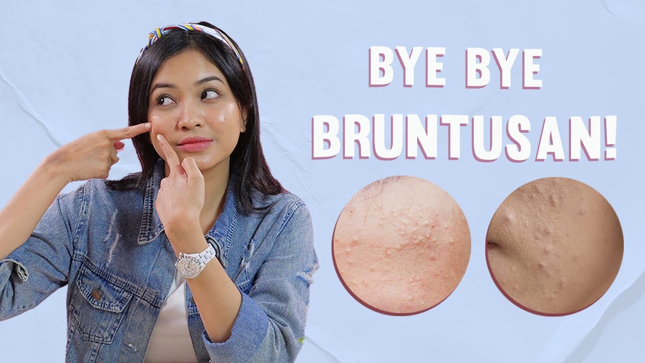 Mudah Banget! Ini Tips Ampuh Menghilangkan Bruntusan Dengan Tepat!