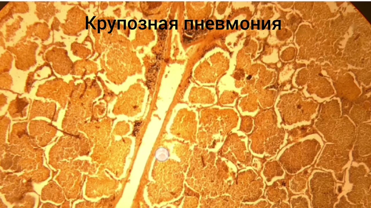 Крупозная пневмония