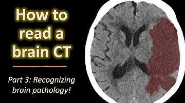 How to read a brain CT (part 3): acute brain pathology
