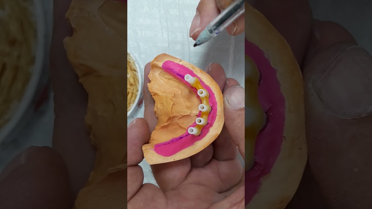 Barra de Protocolo Implanto Suportada