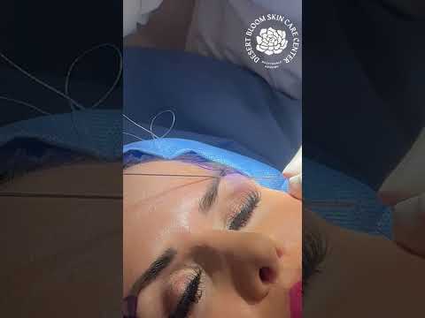 Video about this non-surgical brow repositioning case