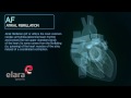 Atrial Fibrillation Cardiac Arrhythmia - 3D Animation