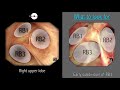 Mastering bronchoscopy for thoracic surgery chapter 2