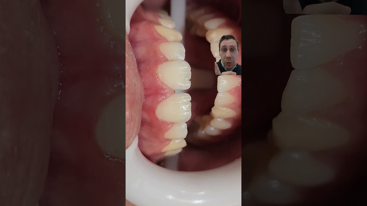 🔴ESPAÇOS ENTRE OS DENTES( DIASTEMAS!)= RESULTADO FECHANDO COM RESINA! #dentist #odontologia #dentes