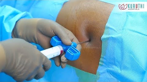 Bone Marrow Aspiration and Bone Marrow Biopsy by Dr.Thilagavathi, BMT Physician, Kuruthi Hospitals