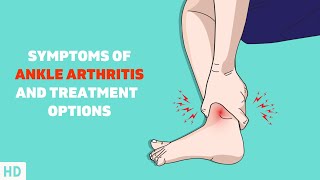Don't Ignore Your Ankle Pain: Understanding Ankle Arthritis