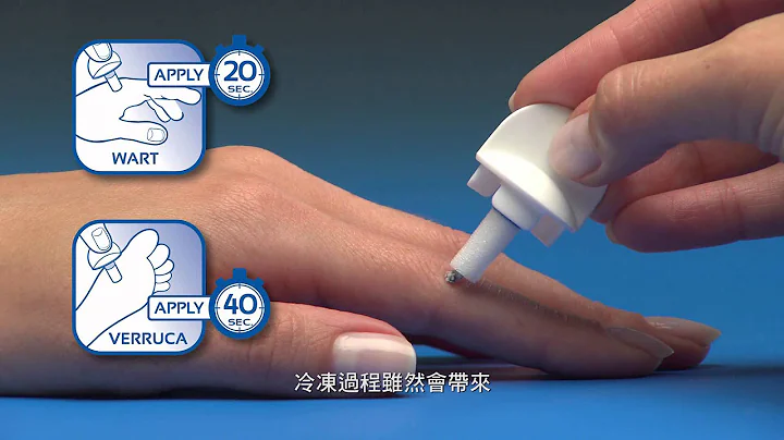 Wartner® 疣立消® 使用说明 (中文配音) - 天天要闻