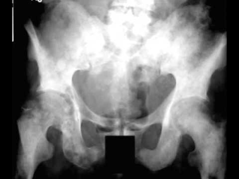 Prostate Metasases to bone on X ray - YouTube