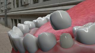 Dental Crowns: What They Are and Why We Need Them
