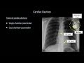 How to Interpret a Chest X-Ray (Lesson 9 - Atelectasis, Lines, Tubes, Devices, and Surgeries)
