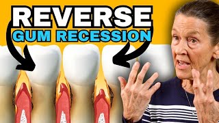 Easily REGROW Gums in 2024 (Heal Gum Recession at-home)