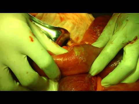 Thủng tạng rỗng (Hollow viscus perforation)