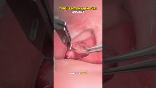 How Tonsil Stones Are Removed Through Tonsillectomy? (3D Animation)