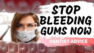 How To Stop Bleeding Gums | Treatment For Periodontal Disease