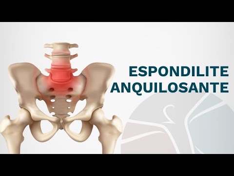 Vídeo: L'espondilitis anquilosant em posarà en una cadira de rodes?