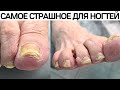 Самое страшное для ногтей 😱😱😱 Подология. Грибок ногтей