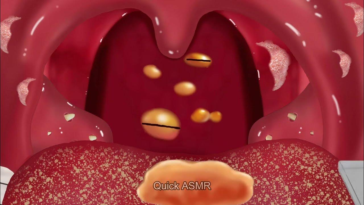 Asmr Tonsil stones removal Asmr animation treatment Deep cleaning