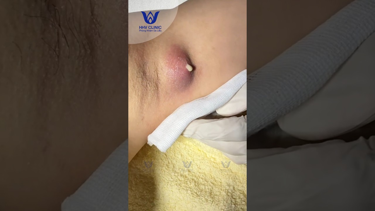 Mụn nách áp xe chà bá ở nách.