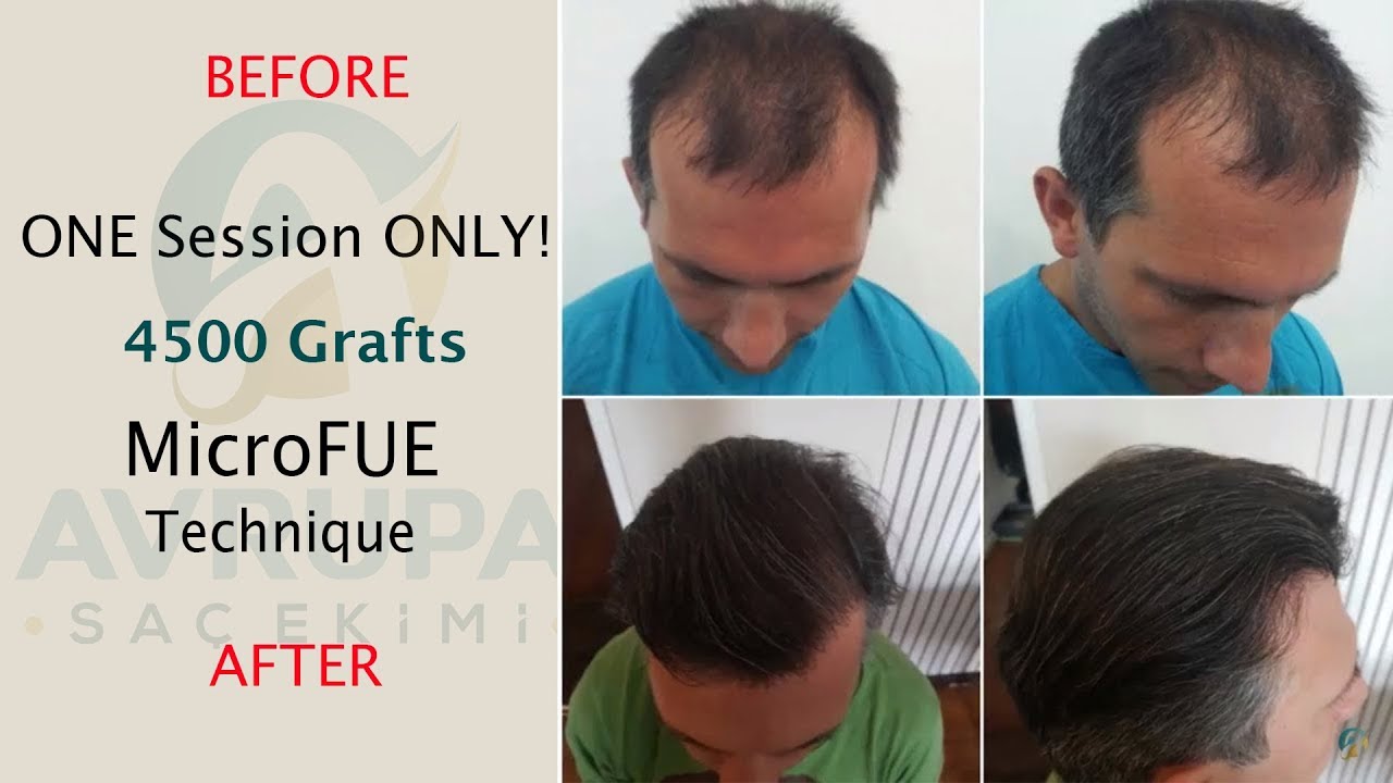 Female Hair Transplant Turkey Hair Transplant Clinic In Turkey