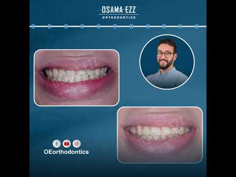 حالة قبل وبعد بتعاني من بروز في الأسنان في الفك السفلي