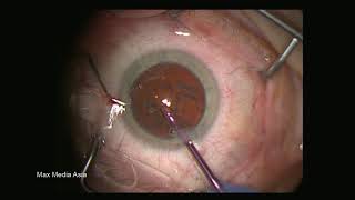 Full Cataract Surgery Lens Implantation Ophthalmology British Surgeon  Patient - YouTube