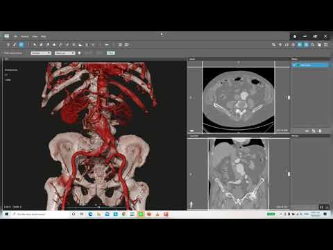 D2P -  Segmentación Vascular