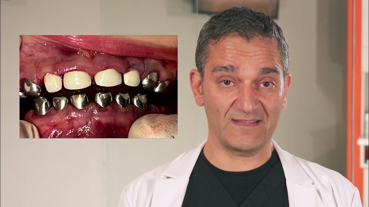 Why You See Silver Crowns on Kids White Zirconia Crowns From Dallas