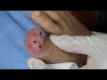 Ep_1952 Big ingrown toenail removal 👣 เห็นแล้ว..ขนลุก 😷 (This clip is from Thailand)