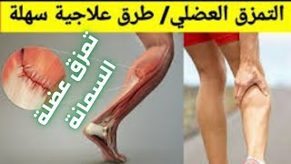 تمزق عضلة السمانة| تمزق عضلة الساق | تمزق بطة الساق | علاج مزق عضلة ربلة الساق| دكتور احمد حسن جمعه