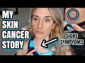 MY SKIN CANCER STORY - MY SIGNS AND SYMPTOMS!